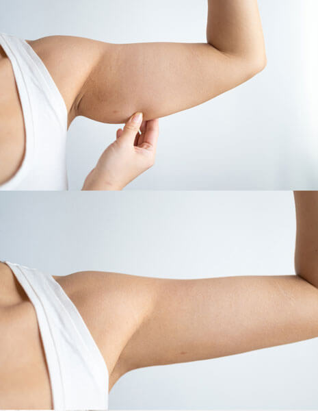 Bewundern Sie die sichtbaren Resultate unserer T-Shape-2-Behandlung an den Oberarmen einer Frau – für straffere und definierte Armpartien